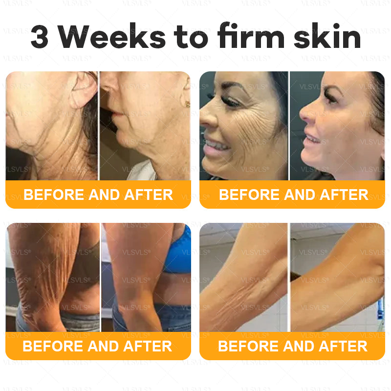 Made and Shipped from USA ✨ VLSVLS® Bee Venom Skin Restoration Cream 🌸 Anti-aging,Hydrating, Skin Repair, Even Tone, Acne and Dark Spot Treatment, Wart and Mole Removal, Psoriasis Relief CS 🔥 LAST DAY 80% OFF 💎